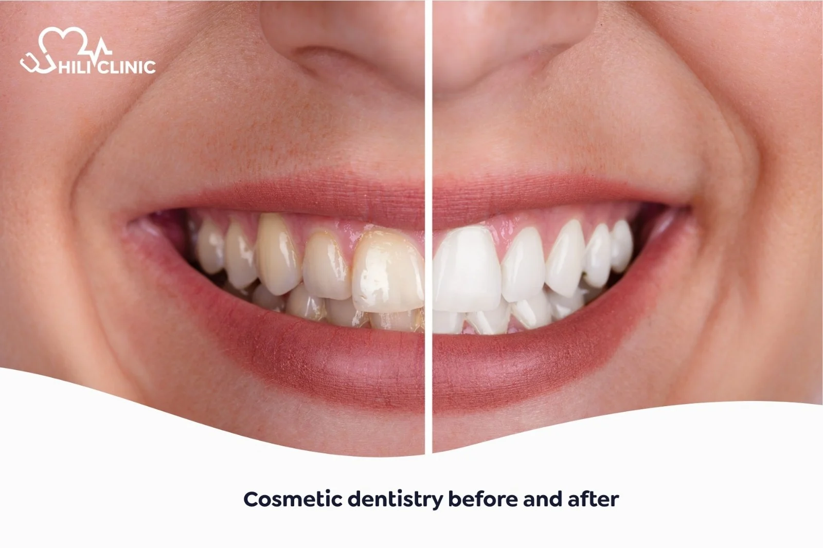Dental Aesthetics Before and After