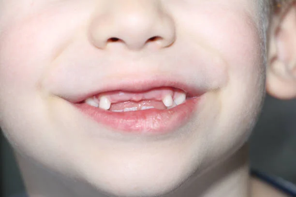Delayed Permanent Teeth After Baby Tooth Loss