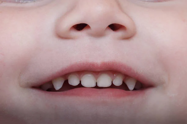 Treatment for Delayed Permanent Tooth Eruption