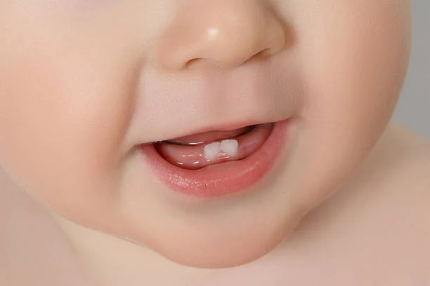 Delayed Tooth Eruption in Infants