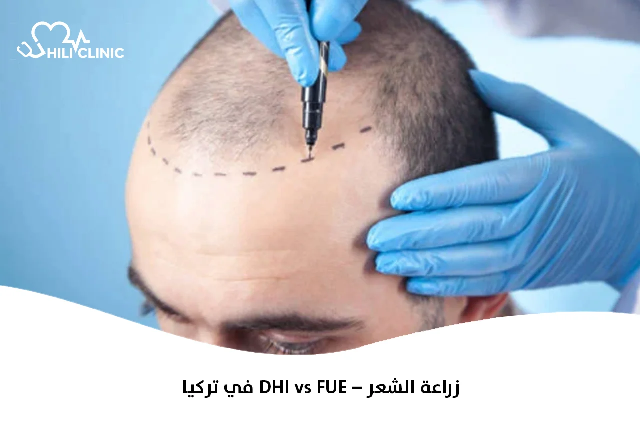 زراعة الشعر – DHI vs FUE في تركيا 