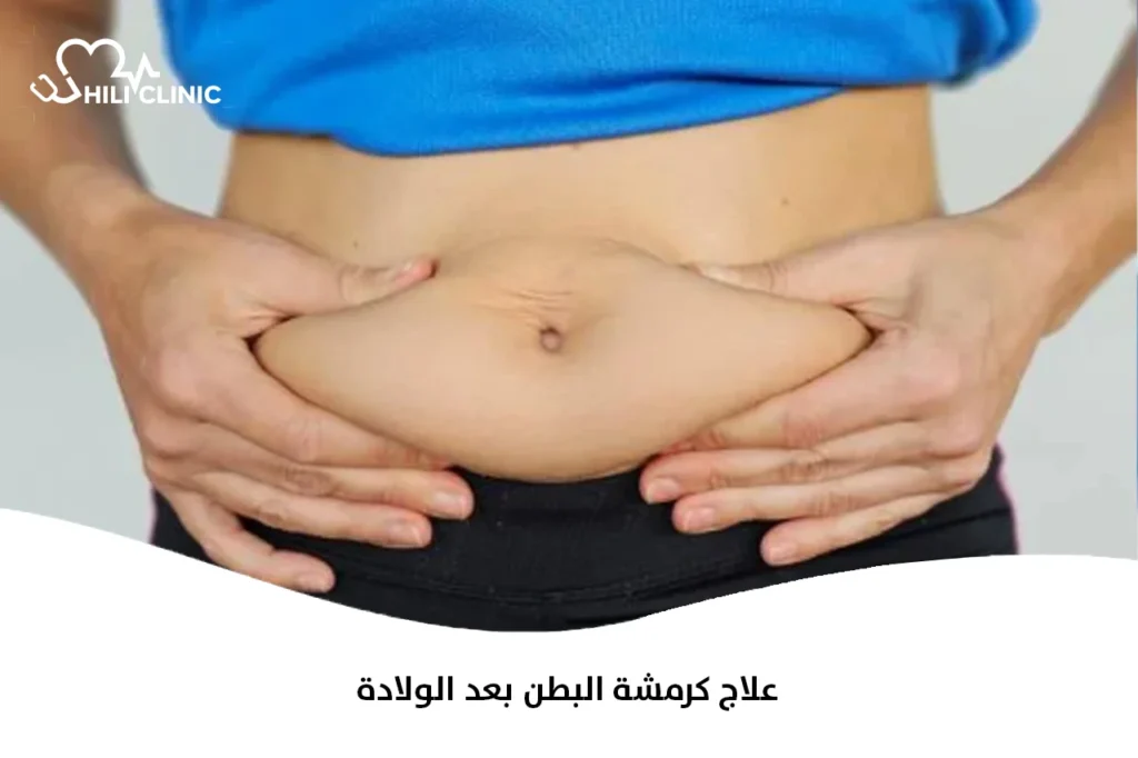 علاج كرمشة البطن بعد الولادة