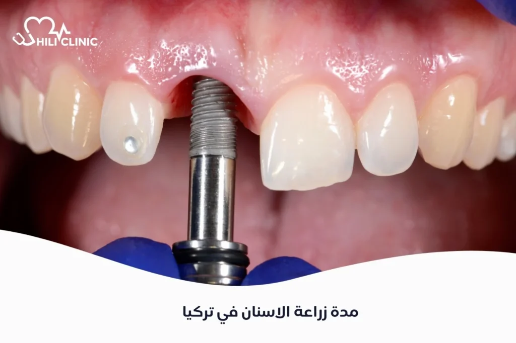 مدة زراعة الاسنان في تركيا