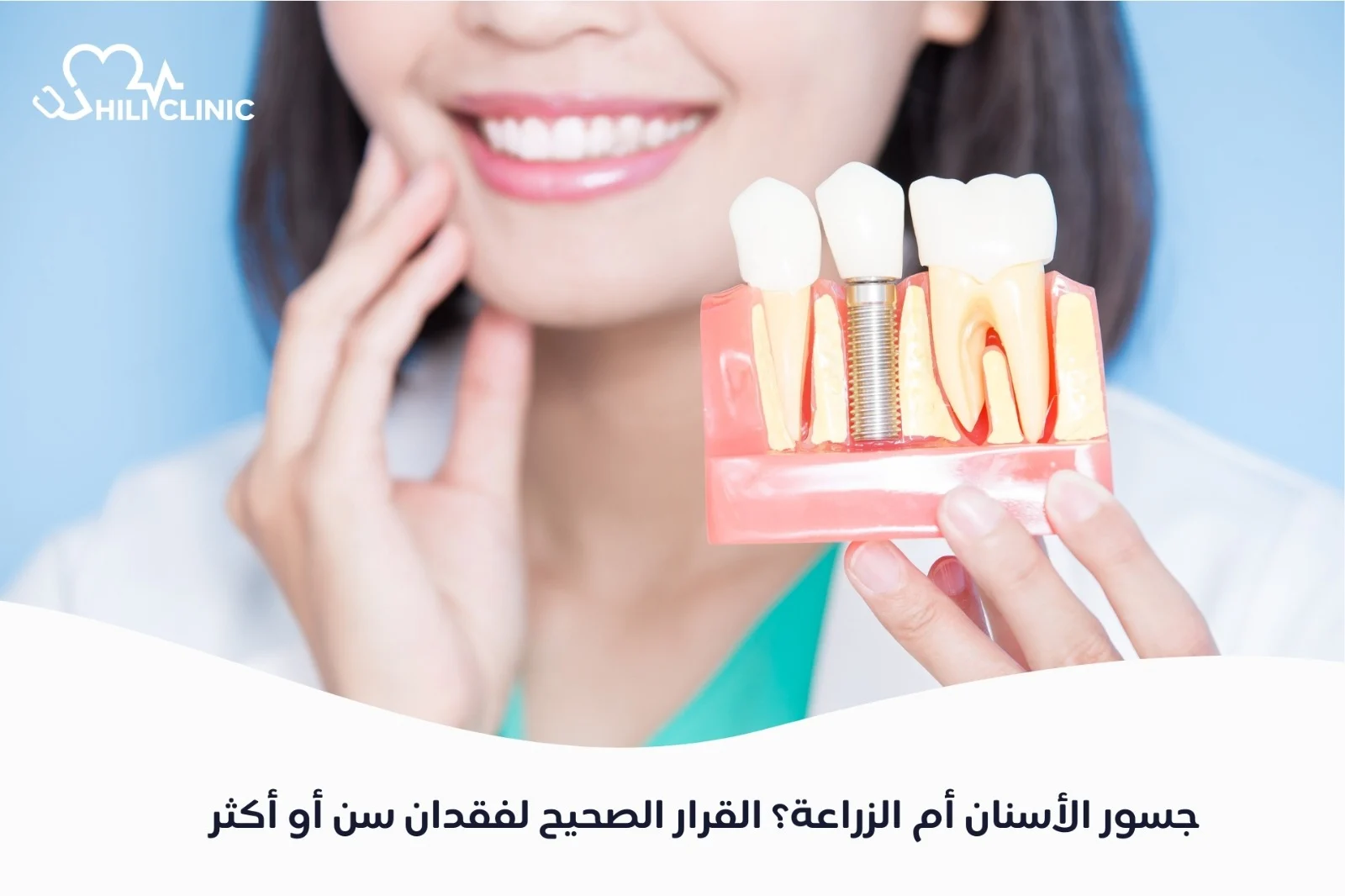 جسور الأسنان أم الزراعة؟ القرار الصحيح لفقدان سن أو أكثر