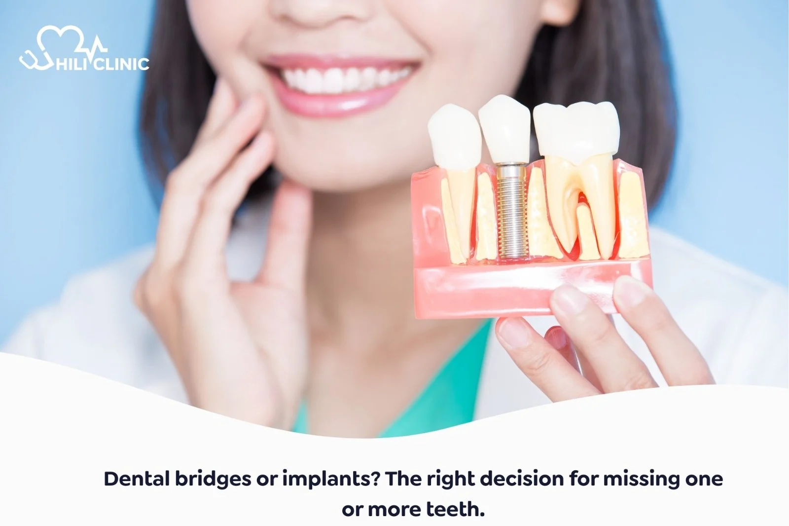 Dental Bridges or Implants? The Right Decision for Losing One or More Teeth