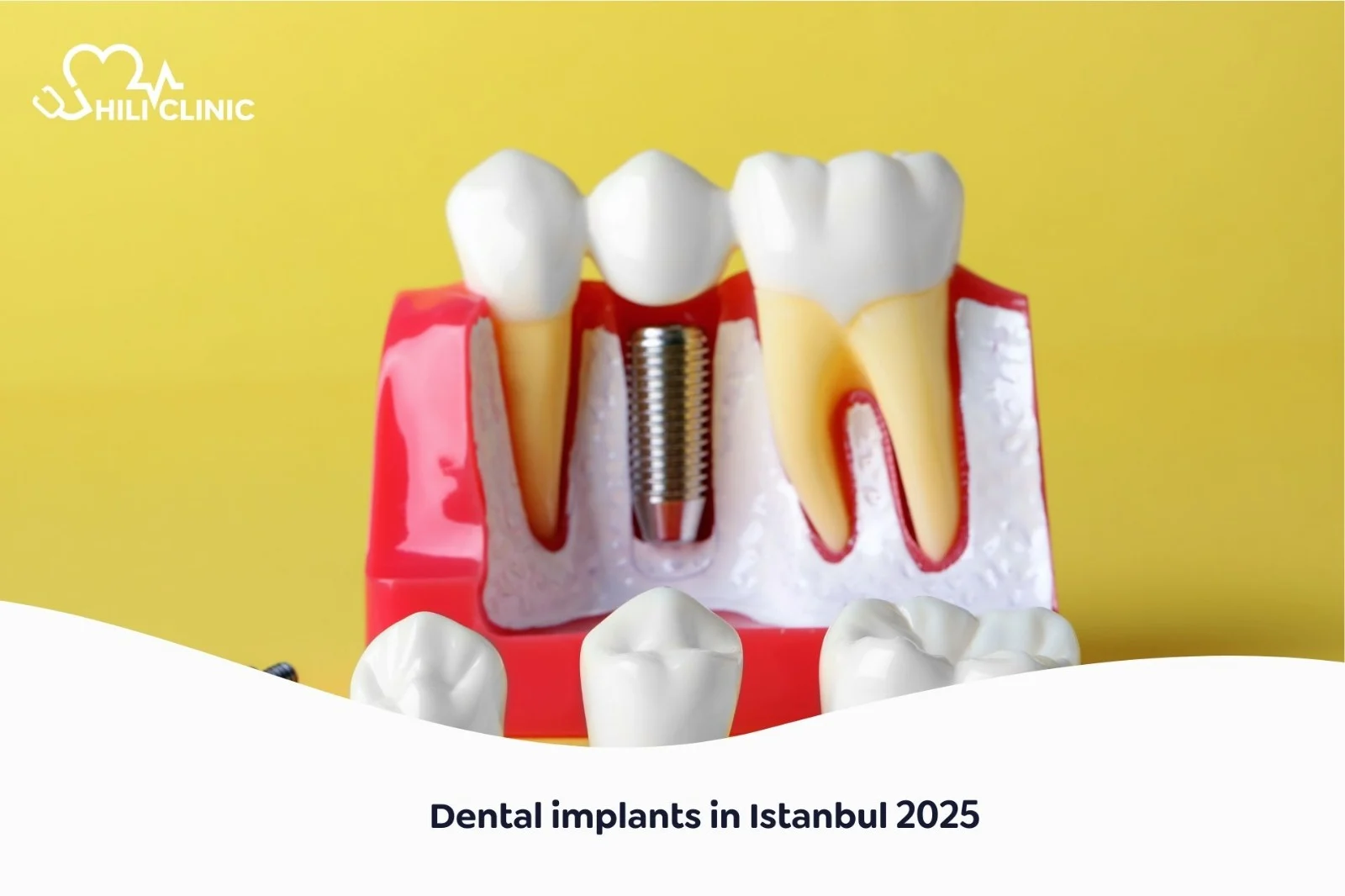 Dental Implants in Istanbul 2025