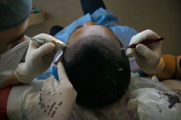 زراعة الشعر – DHI vs FUE في تركيا 