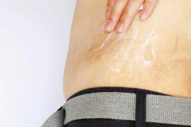 هل تختفي علامات تمدد الجلد بعد الولادة؟ 