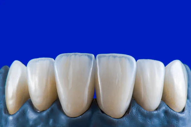 Zircon Dental Veneers
