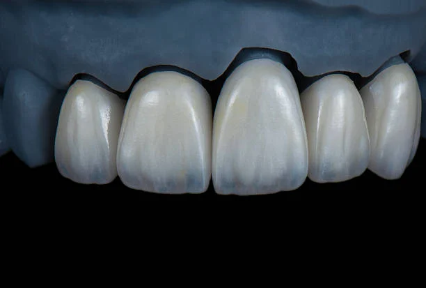 Dental Crowns: Zirconia or Emax?