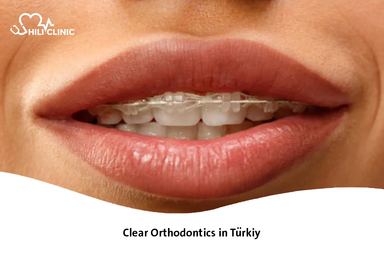Clear Orthodontics in Turkey