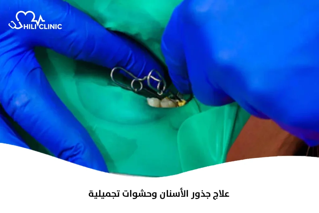 علاج جذور الأسنان وحشوات تجميلية