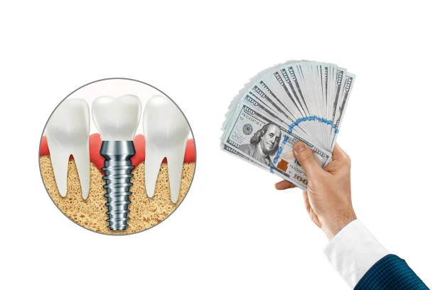 Cost of Immediate Implants