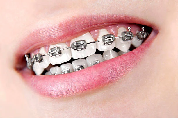 The Difference from Metal Braces
