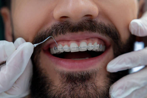 Clear Orthodontics in Turkey