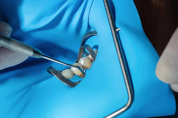 Root Canal Treatment and Cosmetic Fillings