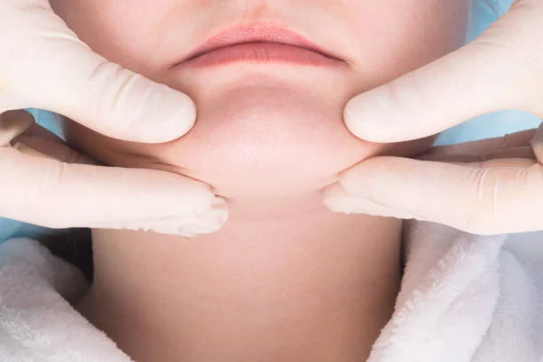 Double Chin Removal Without Pain