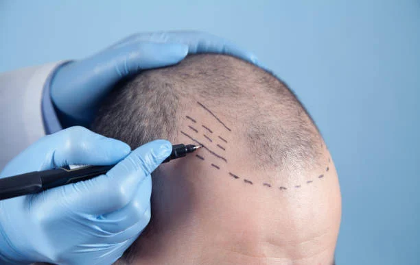 Hair Transplant with Modern Techniques