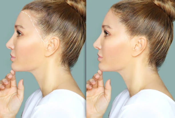 Non-Surgical Double Chin Removal