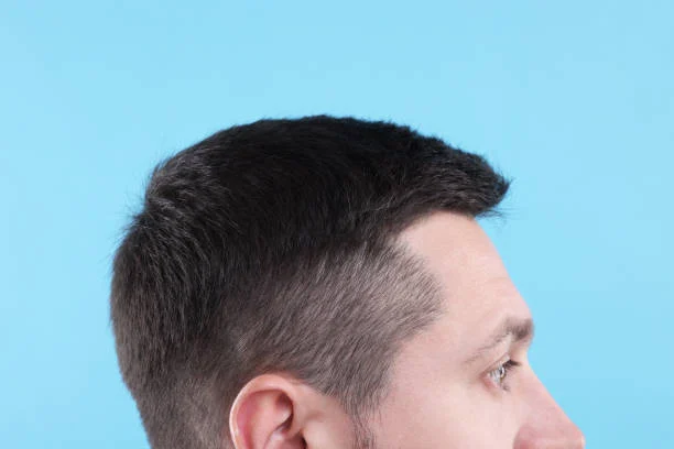 Natural Hair Transplant Results