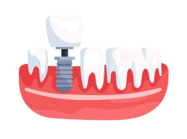 Modern Implant Steps