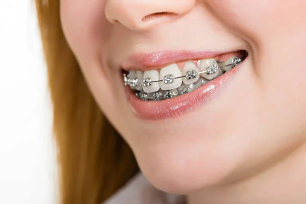 Difference from Metal Braces