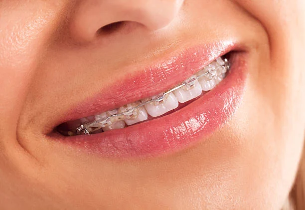Clear Aligners Without Pain