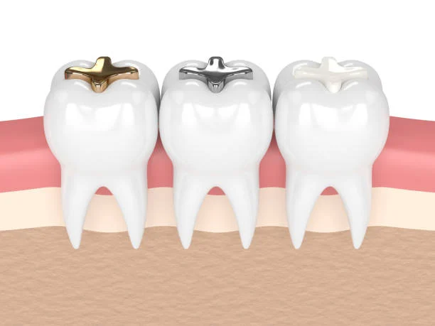 Types of Fillings