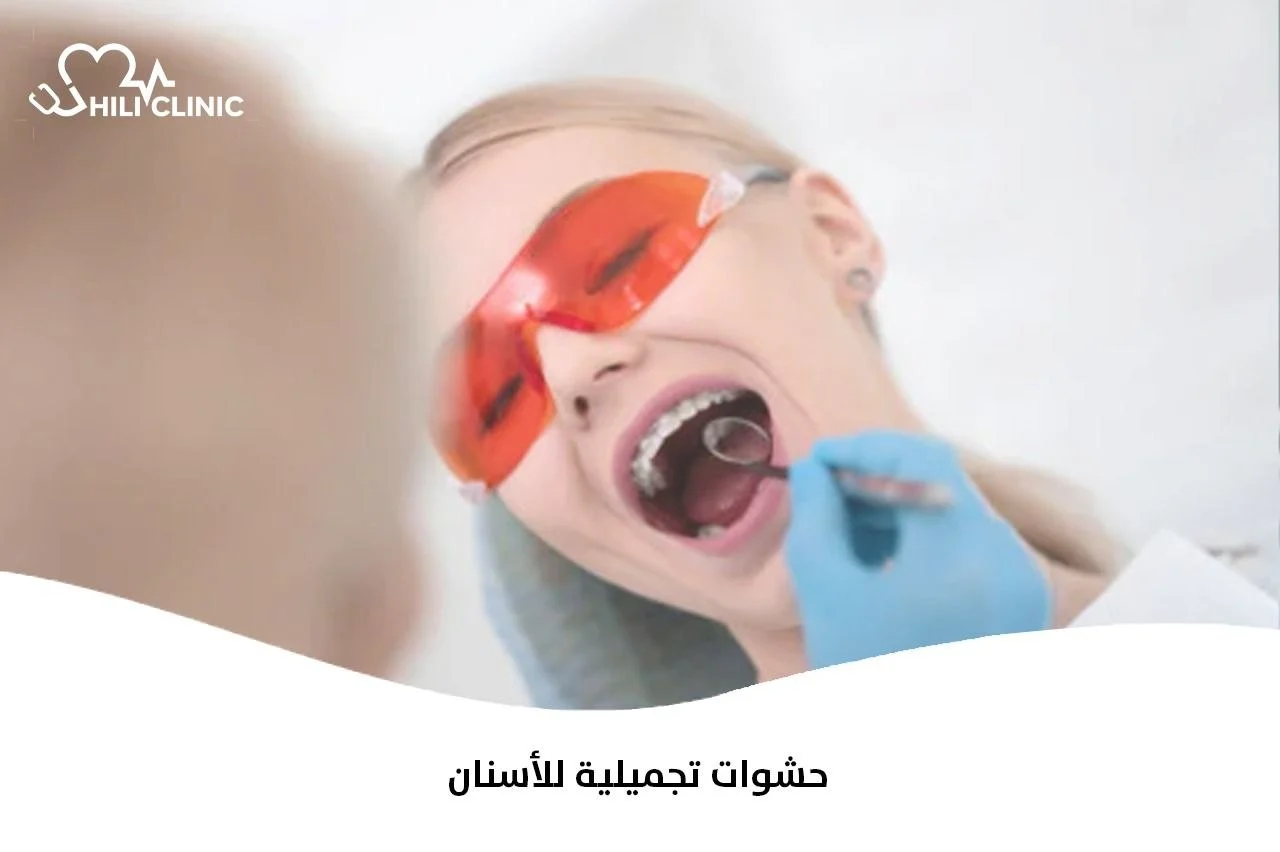 حشوات تجميلية للأسنان