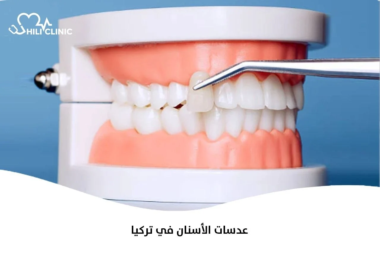 عدسات الأسنان في تركيا