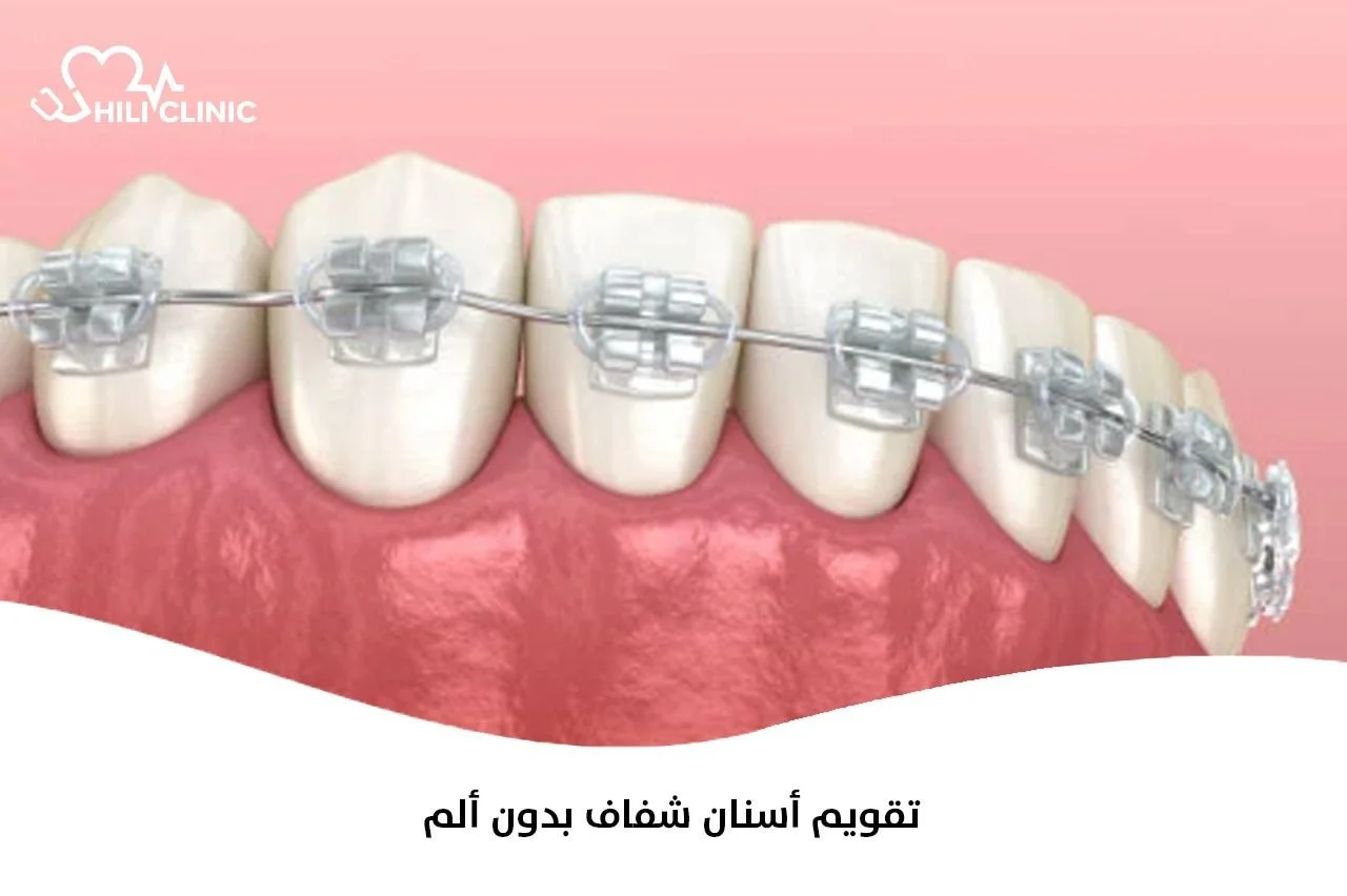 تقويم أسنان شفاف بدون ألم