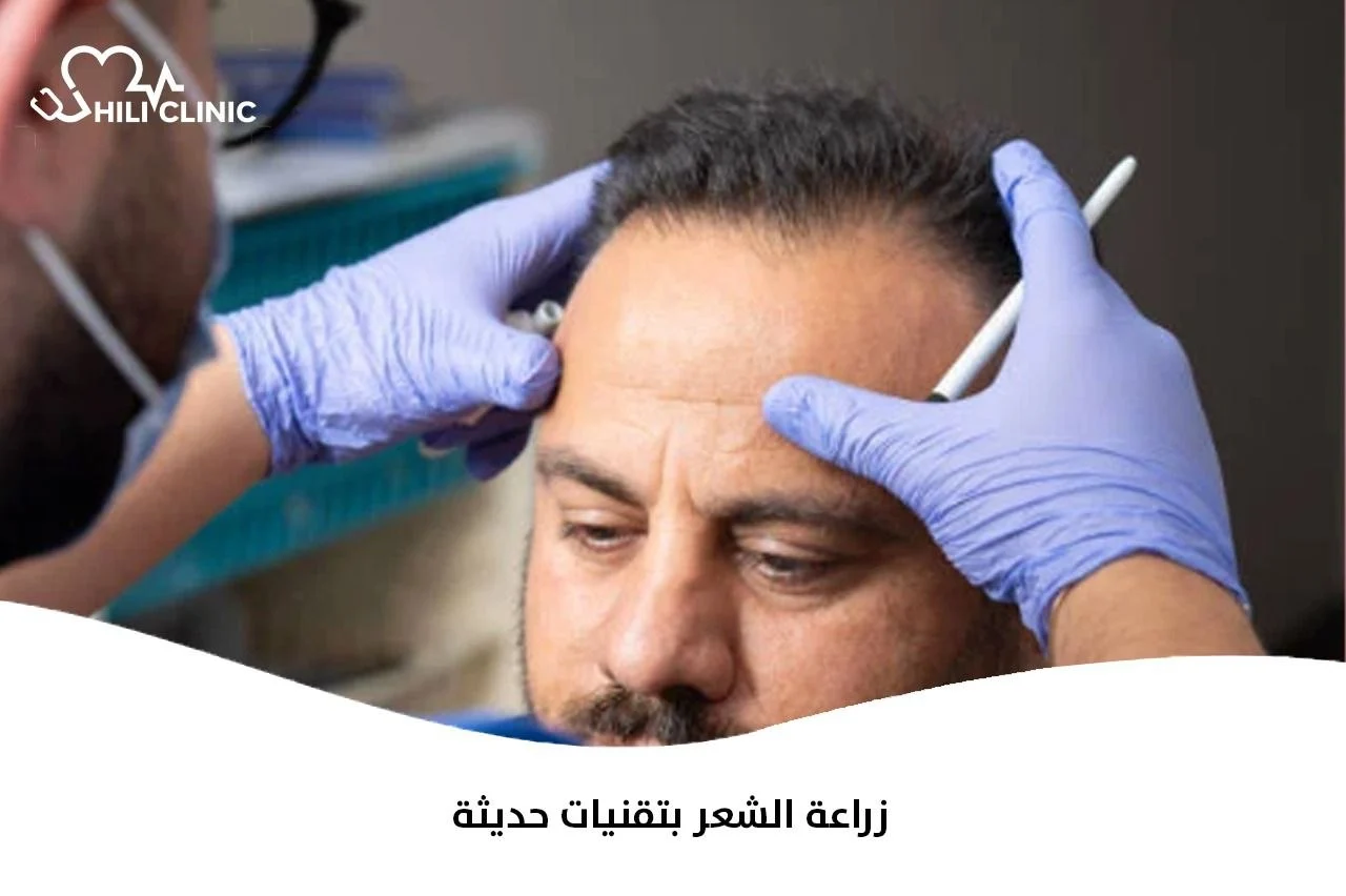 زراعة الشعر بتقنيات حديثة