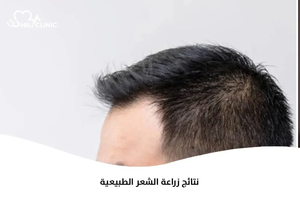 نتائج زراعة الشعر الطبيعية