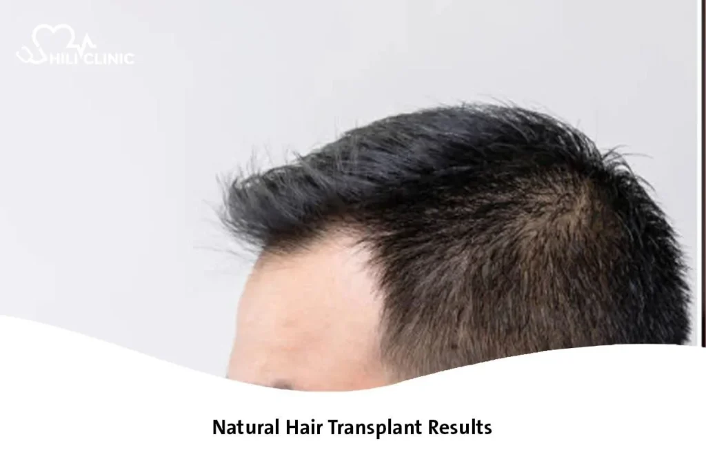 Natural Hair Transplant Results