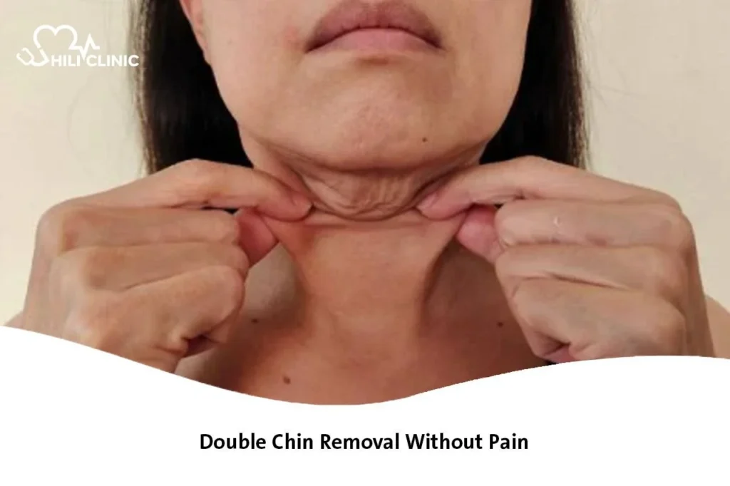 Double Chin Removal Without Pain
