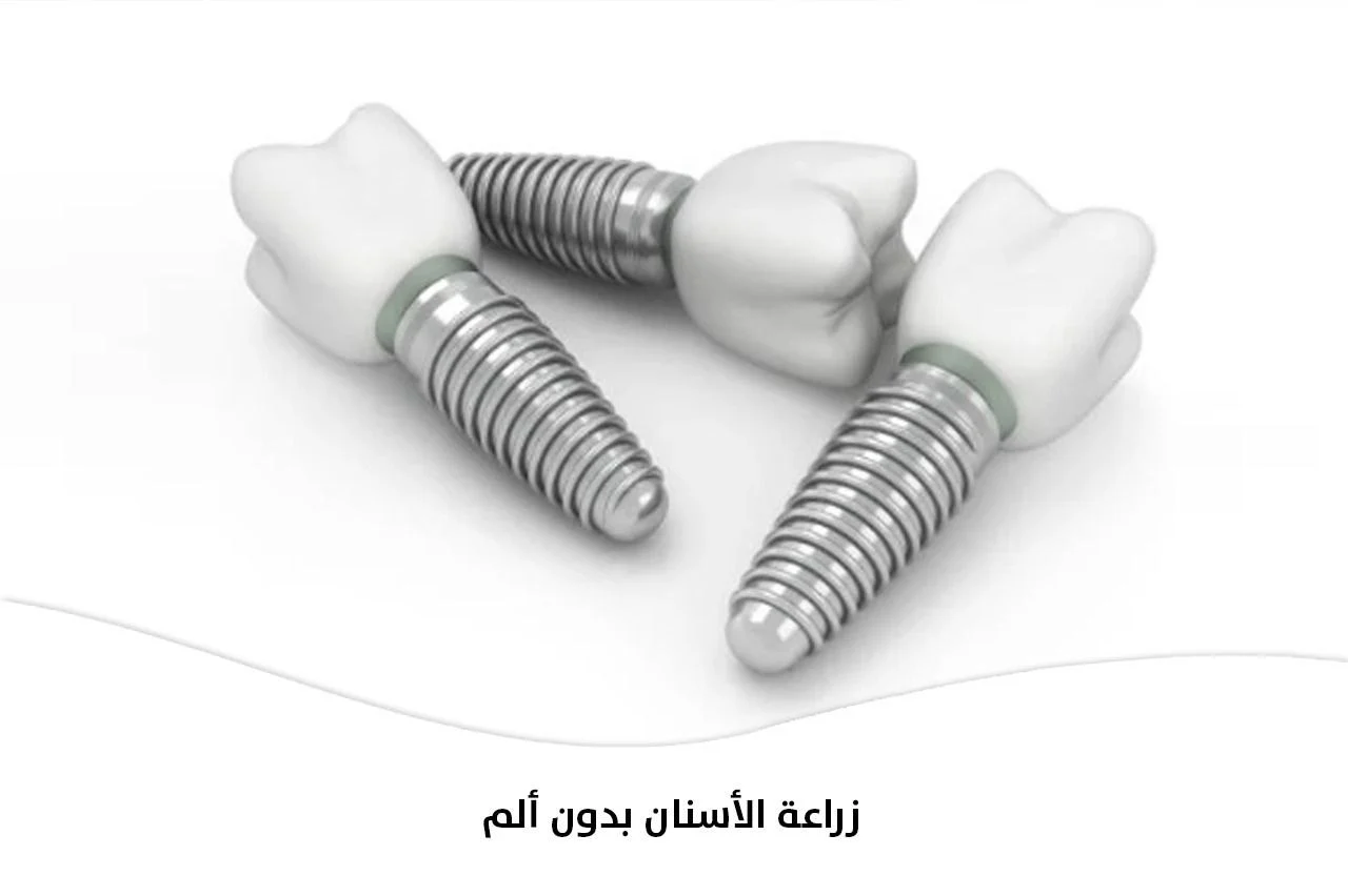 زراعة الأسنان بدون ألم