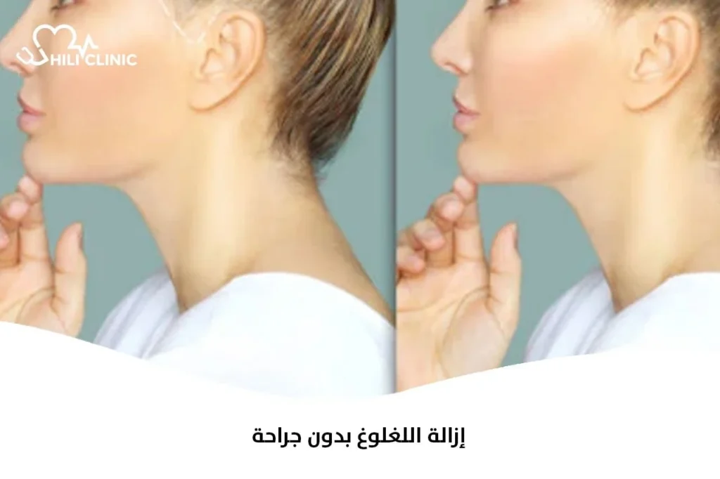 إزالة اللغلوغ بدون جراحة