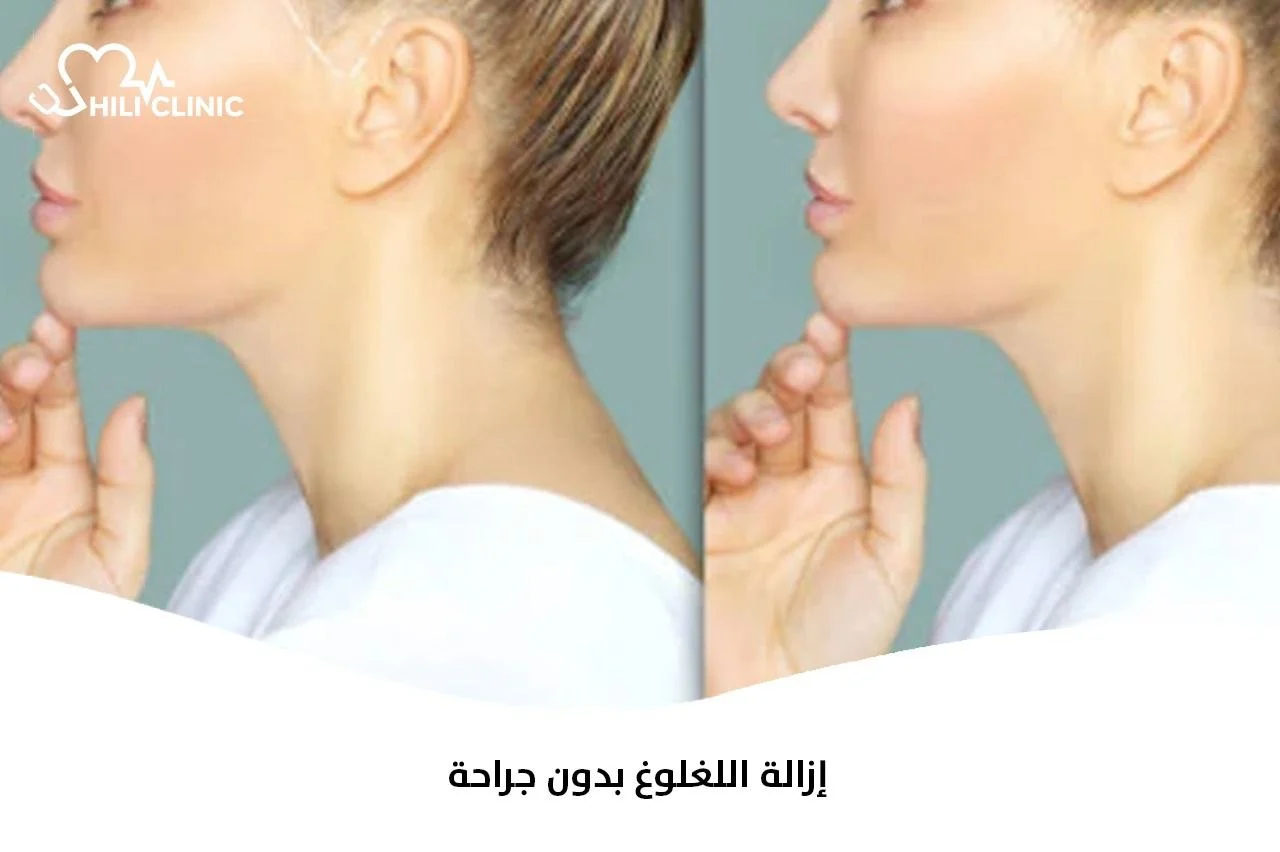 إزالة اللغلوغ بدون جراحة