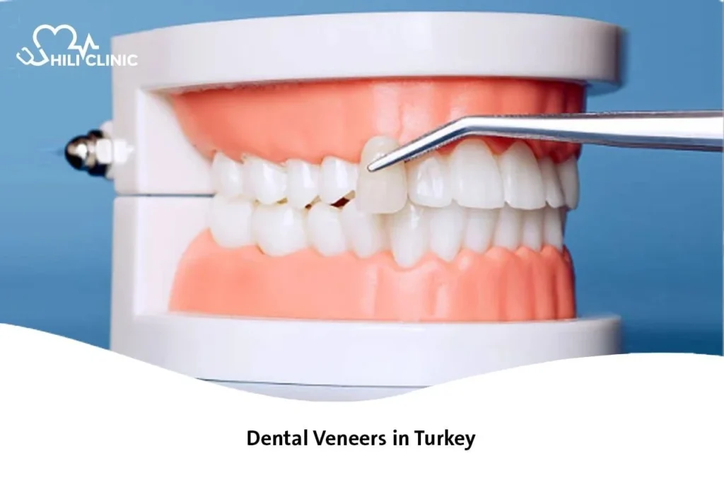 Dental Veneers in Turkey