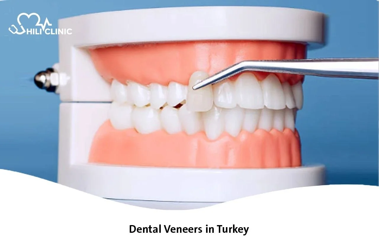 Dental Veneers in Turkey