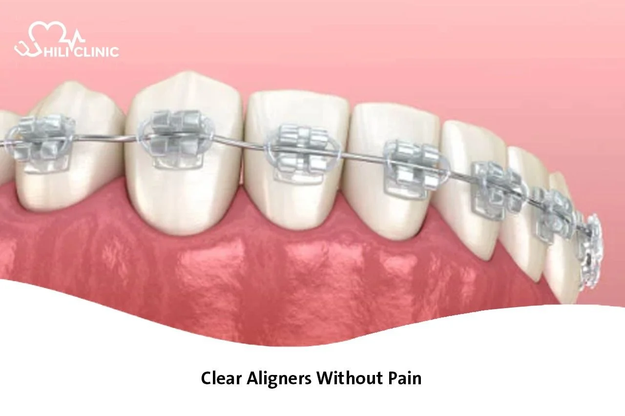 Clear Aligners Without Pain