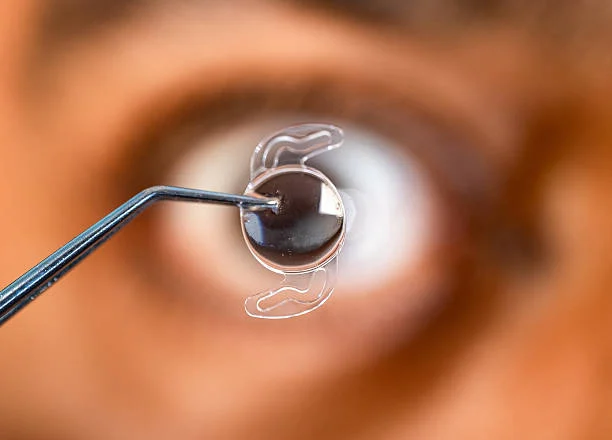 Intraocular Lens Implantation