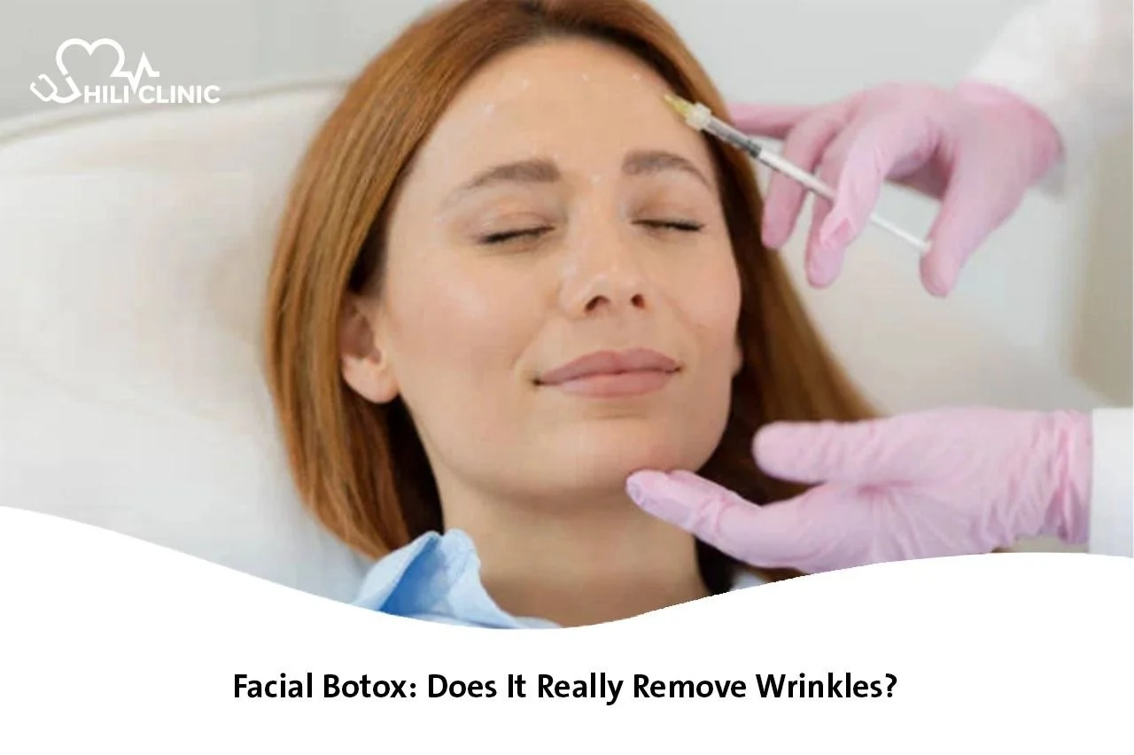 Facial Botox: Does It Really Remove Wrinkles? 2026
