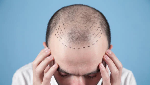 The Difference Between FUE and DHI Techniques: Which Is Best for Your Case?