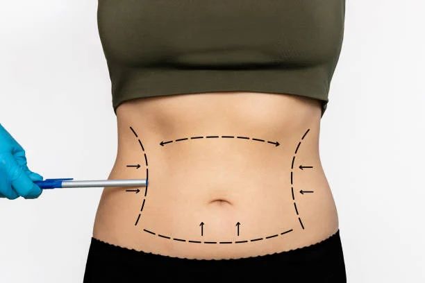 Liposuction and Body Contouring