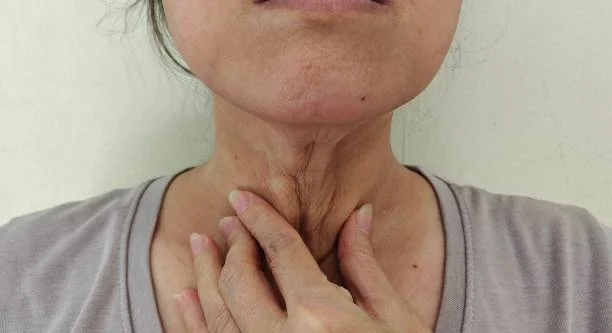 What is a double chin?