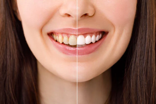 Does Teeth Whitening Damage Enamel? The Complete Medical Truth