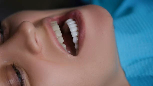 Zirconium Dental Veneers