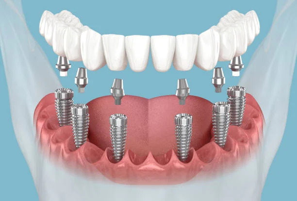 Immediate Dental Implants
