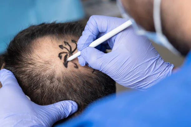 Hair transplant steps